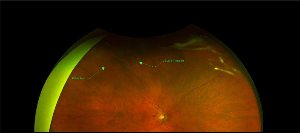 Retinal Tear | Optos Laser Eye Scanner